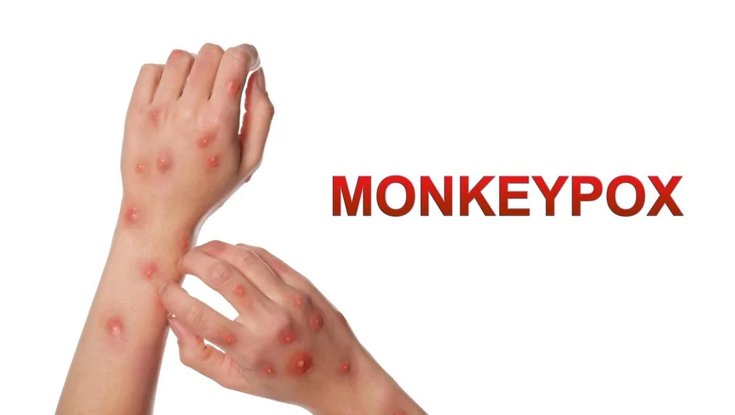 mpox symptoms